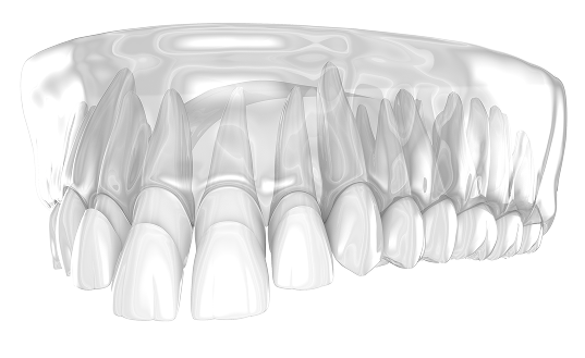 Benefits of Veneers
